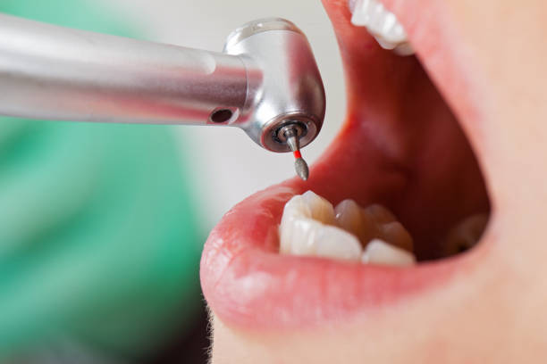 Best Emergency Root Canal Treatment in Mcdonald, PA